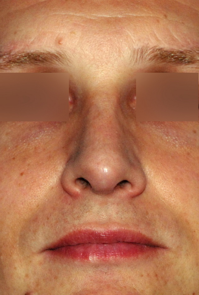 Photos De Rhinoplastie Avec Nez Trop Large Avant Et Apr S R Duire Le Nez