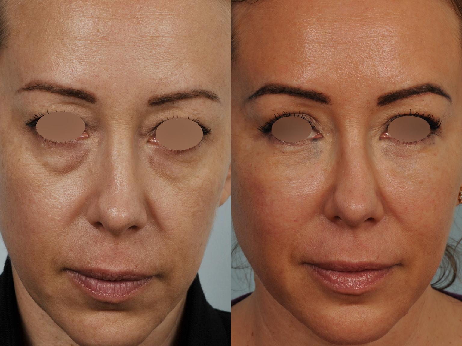 avant-apr-s-lipofilling-mammaire-xncns