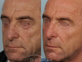 Blépharoplastie inférieure vue de quart duo