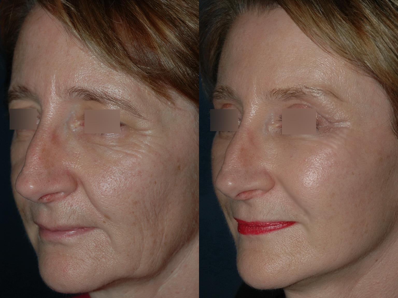 Photos avant et après des liftings du visage les mieux réussi — free download