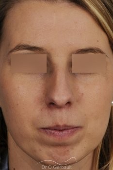 Profiloplastie, avancée du menton par prothèse vue de face avant