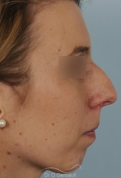 Profiloplastie, avancée du menton par prothèse vue de quart avant