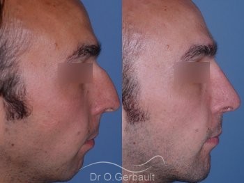 Rhinoplastie chez l'homme, et profiloplastie d'harmonisation vue de profil duo