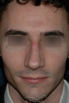 Rhinoplastie chez l'homme vue de face apres