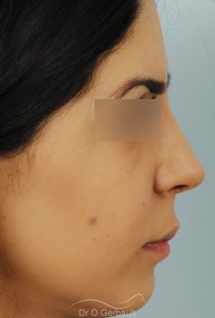 Rhinoplastie ethnique secondaire vue de profil apres