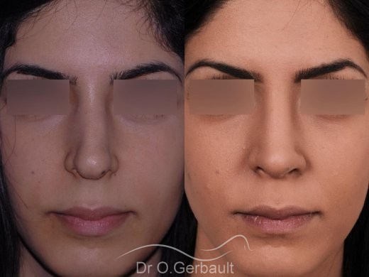 Rhinoplastie ethnique secondaire vue de face duo