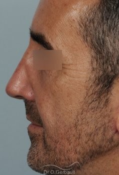 Rhinoplastie fonctionnelle vue de profil apres