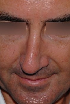 Rhinoplastie fonctionnelle vue de face avant