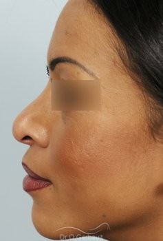 Rhinoplastie secondaire, ailes de nez retractées vue de profil avant