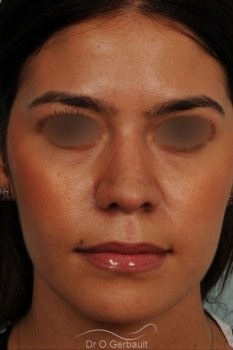 Rhinoplastie ethnique structurelle sur peau épaisse vue de face apres