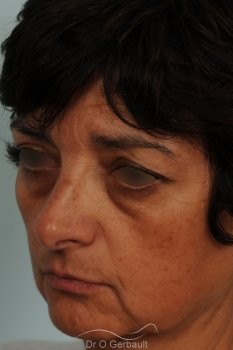 Blépharoplastie lipofillig cernes marqués vue de profil avant