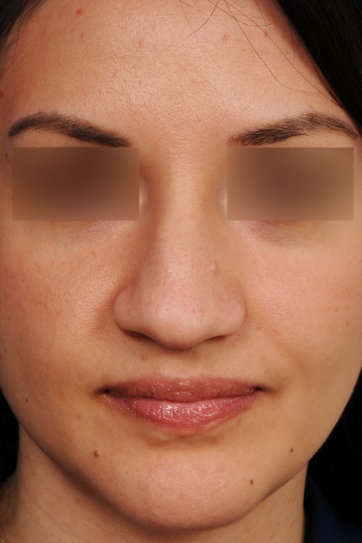 Archives des Falling Nose tip - Chirurgien rhinoplastie Paris : Dr Gerbault