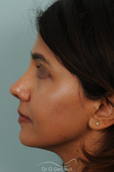 Rhinoplastie primaire sur peau épaisse de type indienne vue de profil apres