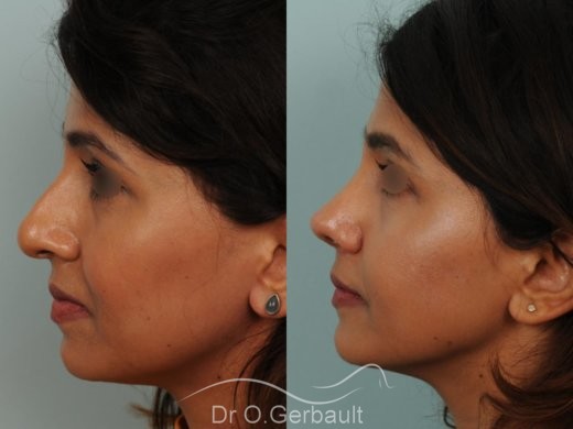 Rhinoplastie primaire sur peau épaisse de type indienne vue de profil avant-apres