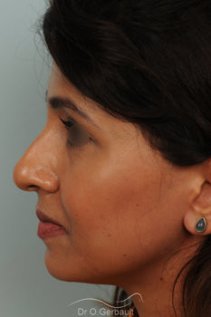 Rhinoplastie primaire sur peau épaisse de type indienne vue de profil avant