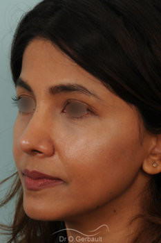 Rhinoplastie primaire sur peau épaisse de type indienne vue de quart apres