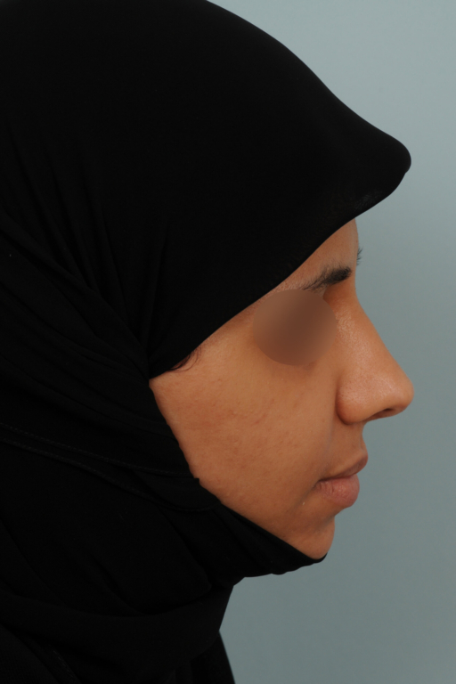 Photos de rhinoplastie ethnique, avant et après nez africain, asiatique...
