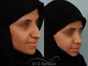 Rhinoplastie ethnique : nez large, bosse marquée, pointe tombante vue de quart avant-apres