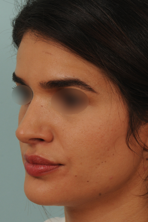 Photos De Rhinoplastie Avec Nez Trop Fort Avant Et Apr s Affiner Le Nez
