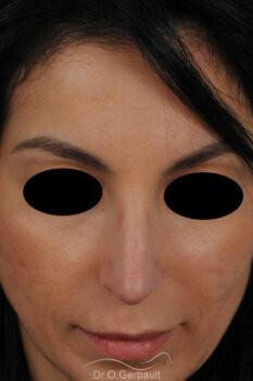 Profiloplastie avec harmonisation du visage vue de face apres