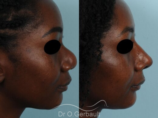 Rhinoplastie ethnique secondaire vue de profil avant-apres