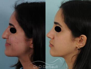 Rhinoplastie chez une jeune femme Libanaise vue de face avant-apres