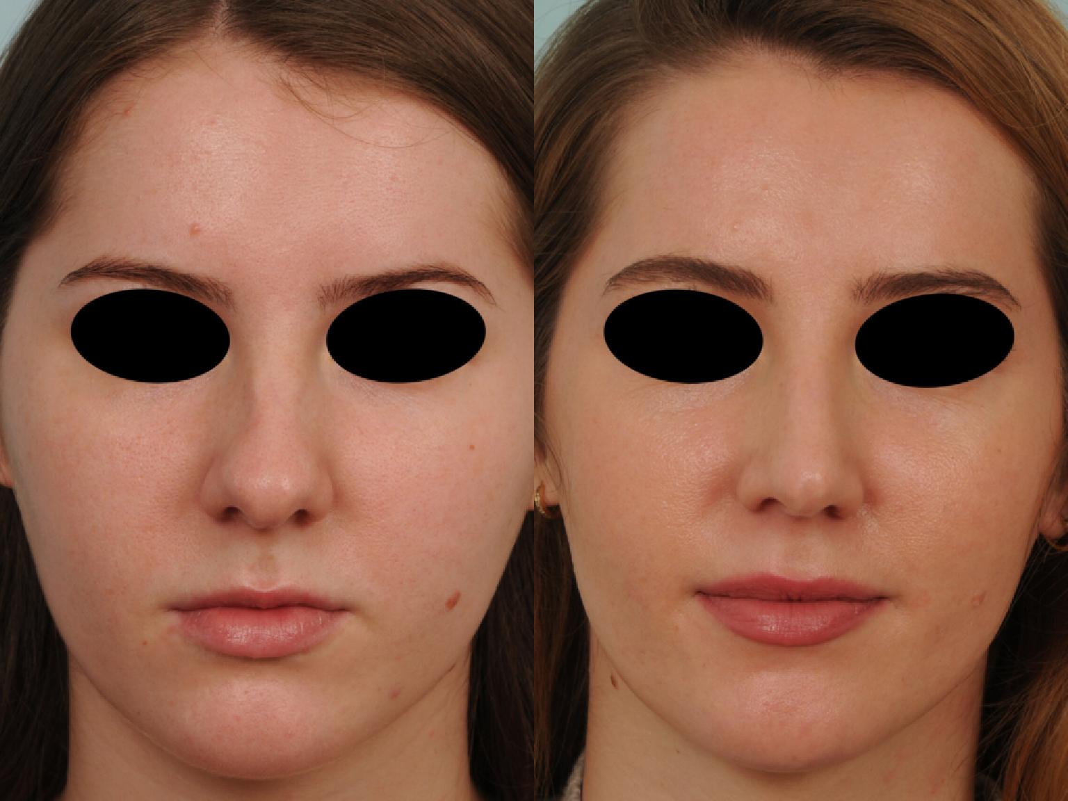 Rhinoplastie avant après photos et exemples de nez refaits