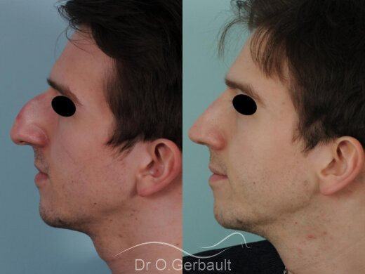 Ultrasonic Rhinoplasty advice from the inventor Dr. Gerbault