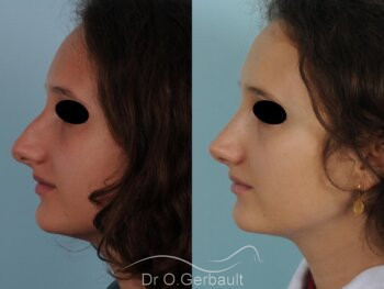 Rhinoplastie pour symétriser un nez très asymétrique vue de profil avant-apres