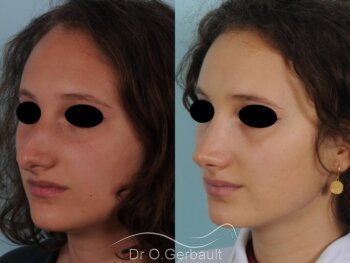 Rhinoplastie pour symétriser un nez très asymétrique vue de quart avant-apres