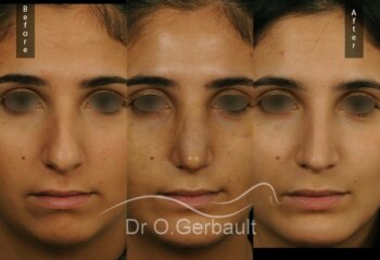 Evolution rhinoplastie ultrasonique profiloplastie